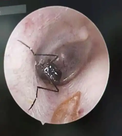 可怕!女子感觉耳朵里有异物,医生从里面取出了一只活蜘蛛