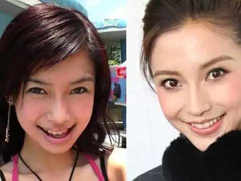 图angelababy带牙套带牙套前后惊人巨变