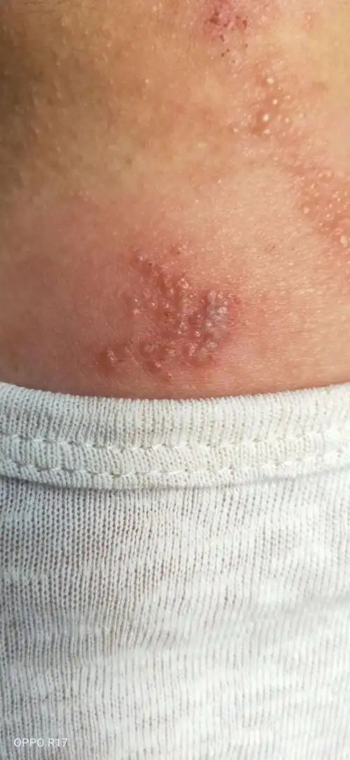 没有明显痒疼的带状疱疹,也需要来皮肤科门诊面诊.