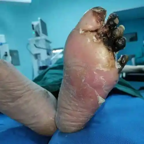 医附属三院巧妙治疗让重度糖尿病患者免除截肢之苦_创面_左足背_肢体