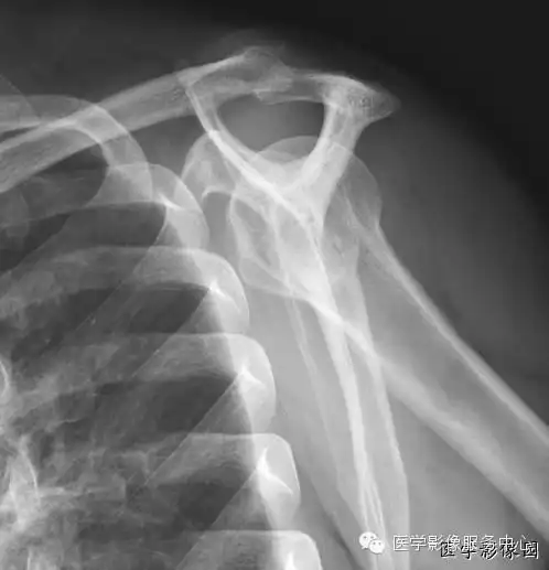 肩关节岗上肌出口位即y位