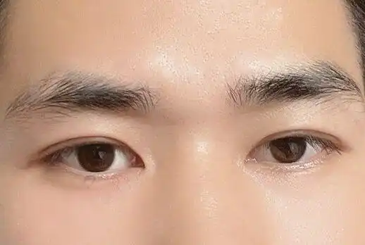 男生双眼皮