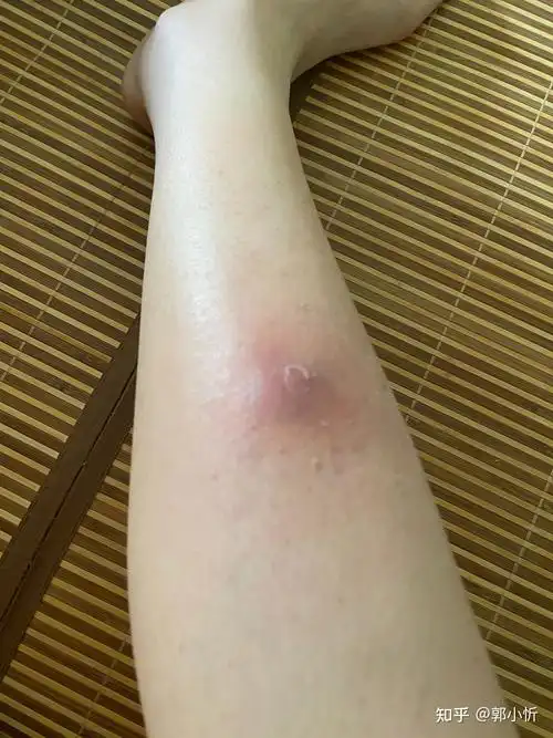 小腿火疖子从发展到切开全过程记录 - 知乎