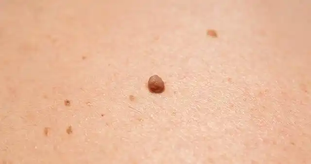 皮肤上长出的"肉瘤"是怎么回事?会癌变吗?