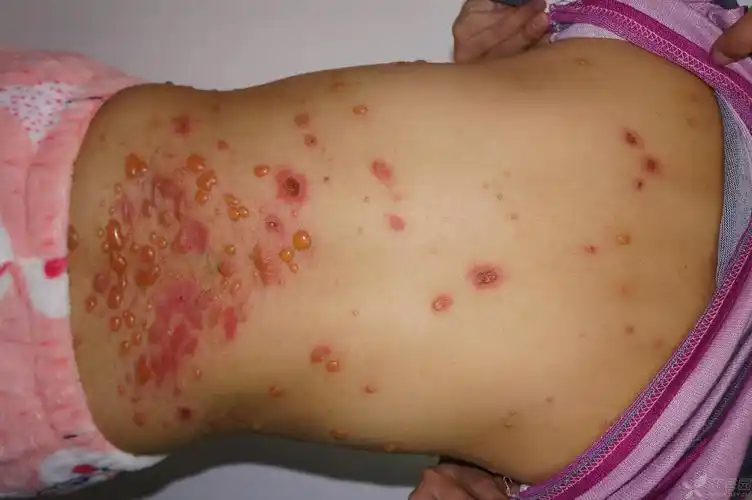 【病例讨论】年轻女性 周身水疱,大疱 - 皮肤性病 -丁香园论坛