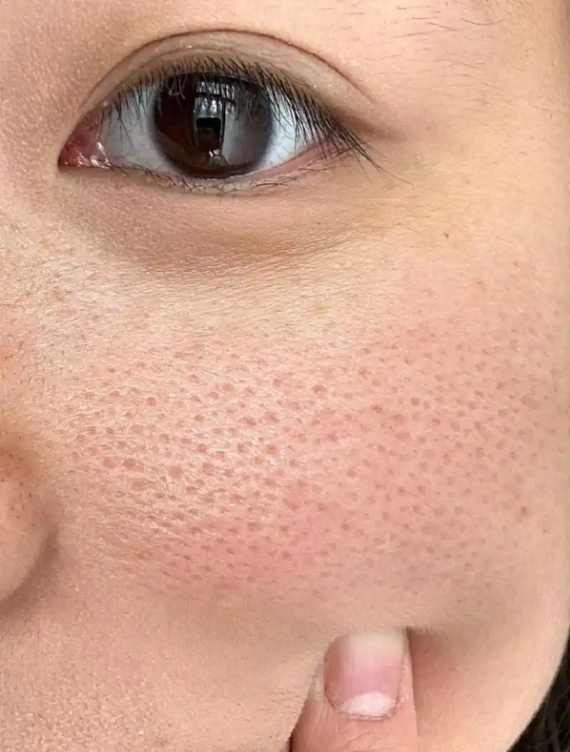 医美科普挑战赛#  许多人都有一个共同的困扰:脸上的毛孔粗大.