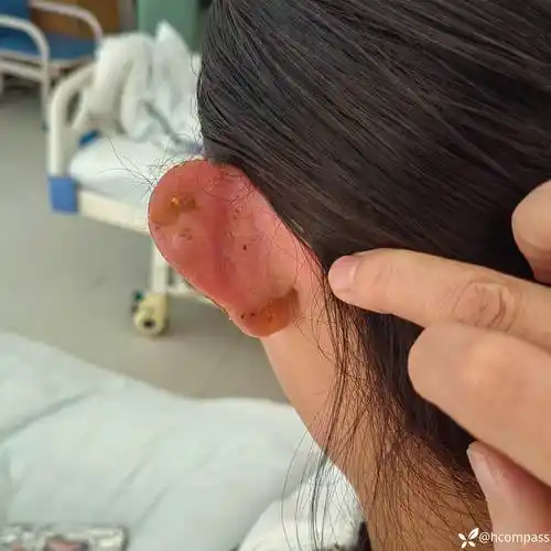 耳廓脓肿耳廓血肿病情已持续半月术中切开刮除坏死软骨术后首次换药
