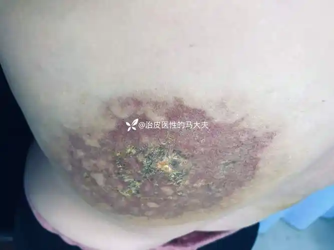 典型皮损狼疮性脂膜炎