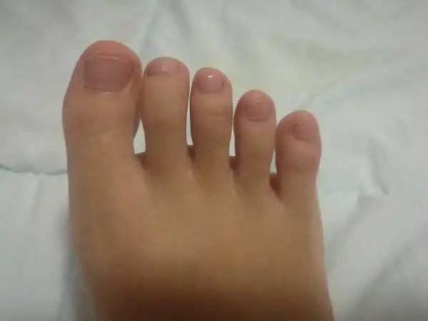 我的大母脚趾正常吗