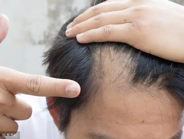 职场压力大90后脱发硬生生活成60后不如试试这两点