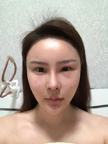 苹果肌额头加太阳穴填充,填充一个月脸部都消肿了,眼睛永远这样不消肿