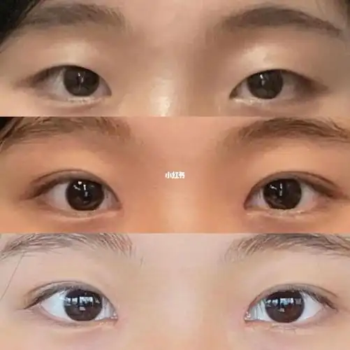 自然开扇北京双眼皮_双眼皮_单眼皮_北京双眼皮_美妆_医美整形