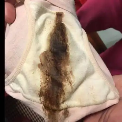 怀孕怀孕36周有褐色液体流出,是什麼情况啊?好担心!