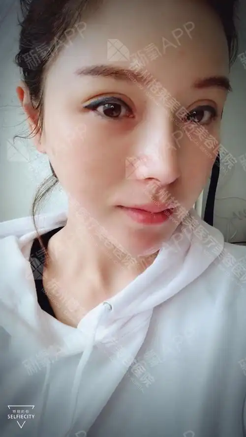 zz_自体脂肪全脸填充第15天美丽日记