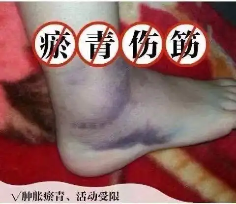 大药房直售 诺方洲跌打损伤止痛膏贴红肿淤青崴脚肌肉拉伤扭伤消肿