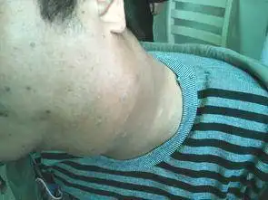 淋巴癌是怎么形成的?肿瘤医师告诉你答案