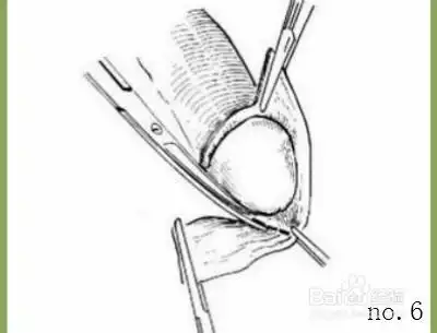 包皮手术详细过程