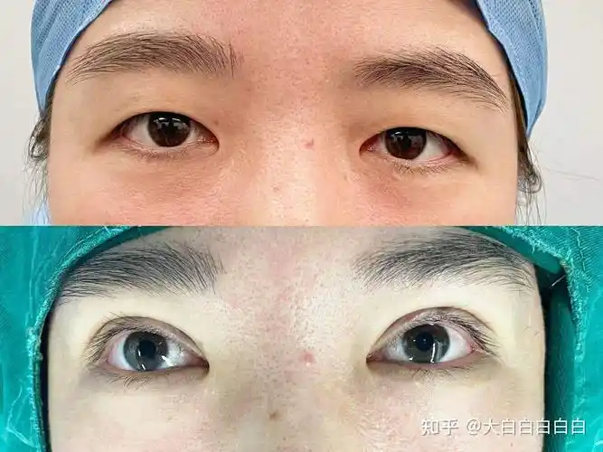 三点定位重睑术恢复过程记录