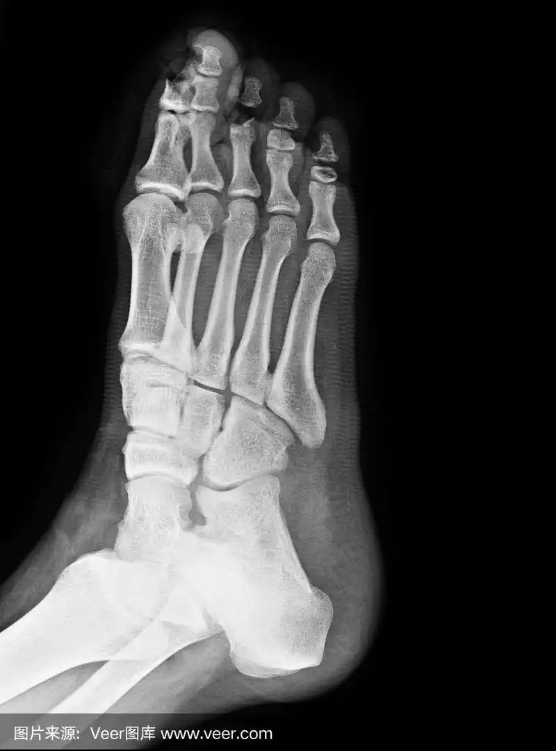 足部骨折患者的x线照片