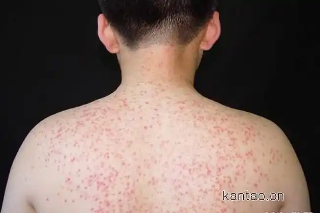 毛囊炎最佳治疗方法 看看毛囊炎图片到底怎么治疗最好