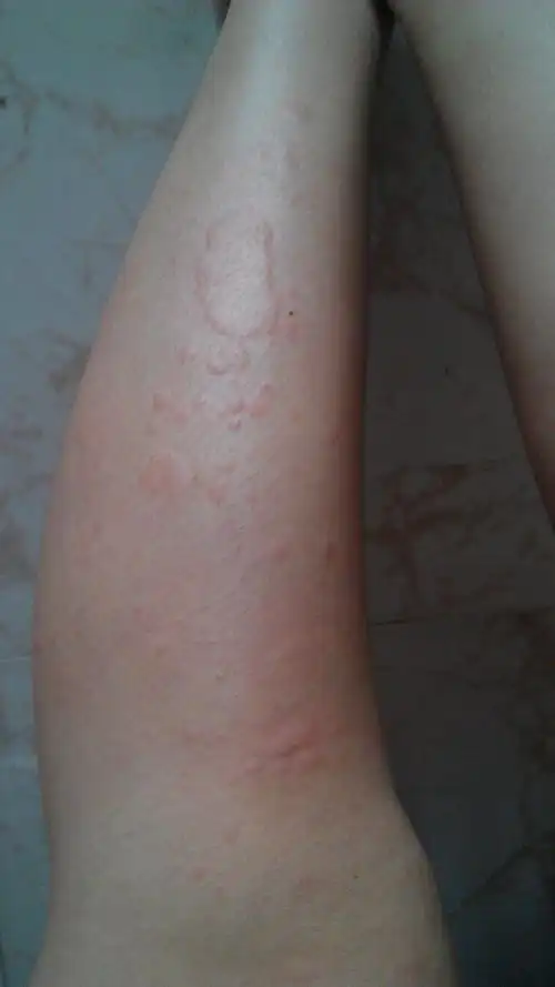 突然全身长包包,很痒