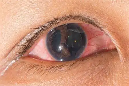 眼睛红血丝是怎么回事怎么去除眼睛红血丝