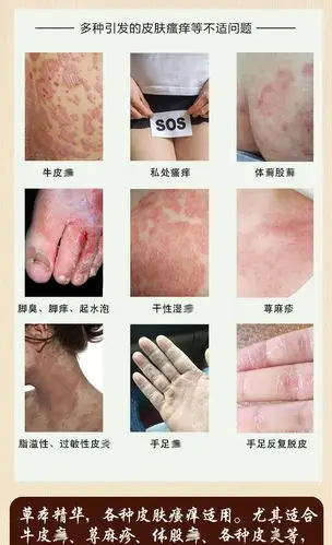 牛皮癣大腿内侧股癣皮炎面部头癣过敏皮肤瘙痒湿疹止痒药膏荨麻疹_优