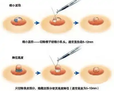 女性乳头内陷,5种方法帮你"拔"出来!