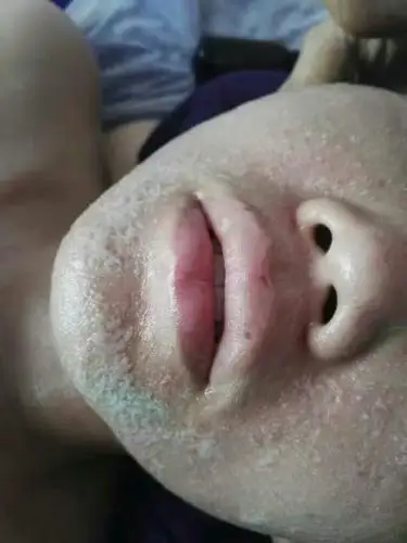 乳腺增生调理,脸部化妆品过敏调理后效果!