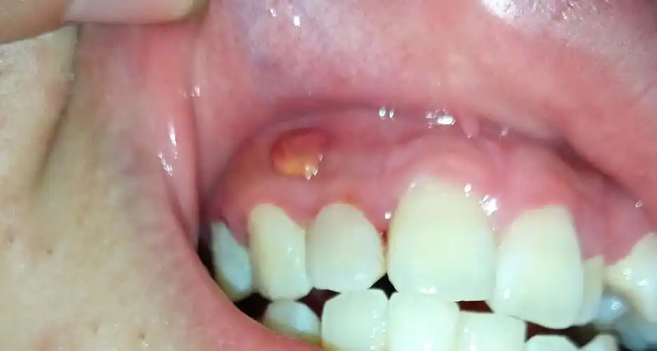 大概近一年左右,牙龈上面长了一个小包,软软的还会滑动,不疼不