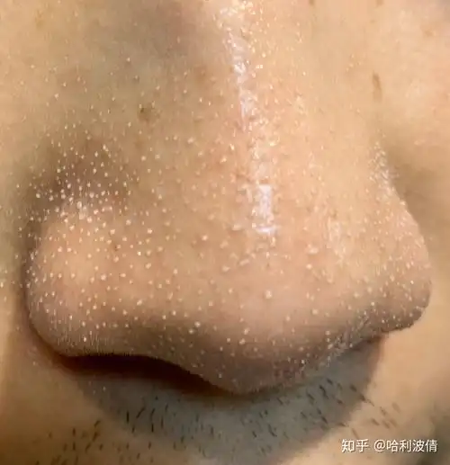 鼻头上的毛孔因为挤了几次黑头而变大,还有救吗,如果现在停手它会慢慢