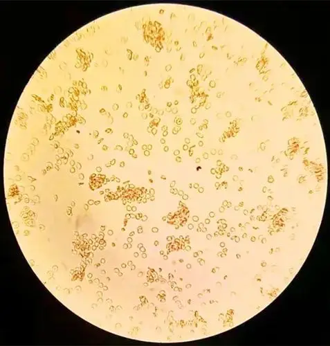 正定型为ab型,反定型为a型,且反定型侧与试剂b型红细胞凝集强度比较弱