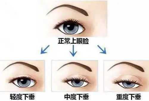 上睑下垂的几种程度