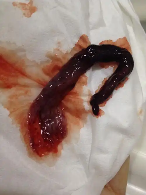 引起消化道大出血的疾病 流产大出血属于疾病险