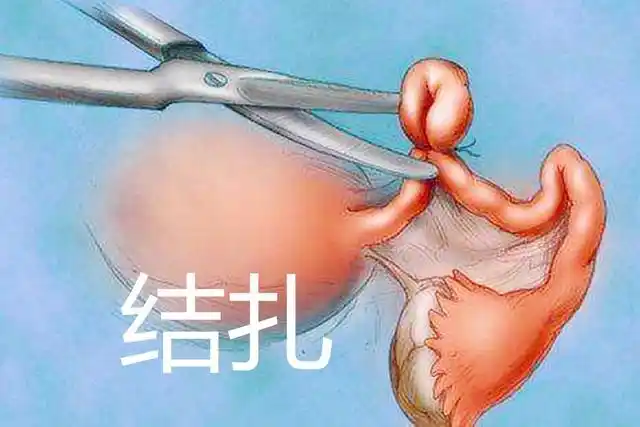 相对于女性上环来说,男性结扎的方式并不普遍.