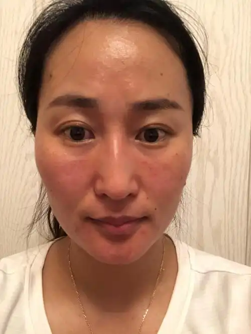 虽然皮肤状态不好～我还是去运动了～只是为了让自己提高免疫力～我就