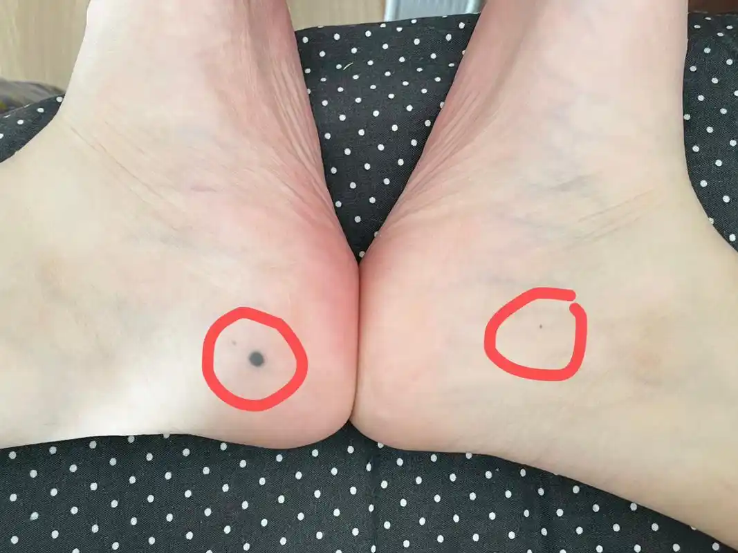 脚后跟侧面长痣 左脚痣长了很多年,长到这么大再没变化过,高出皮肤,我