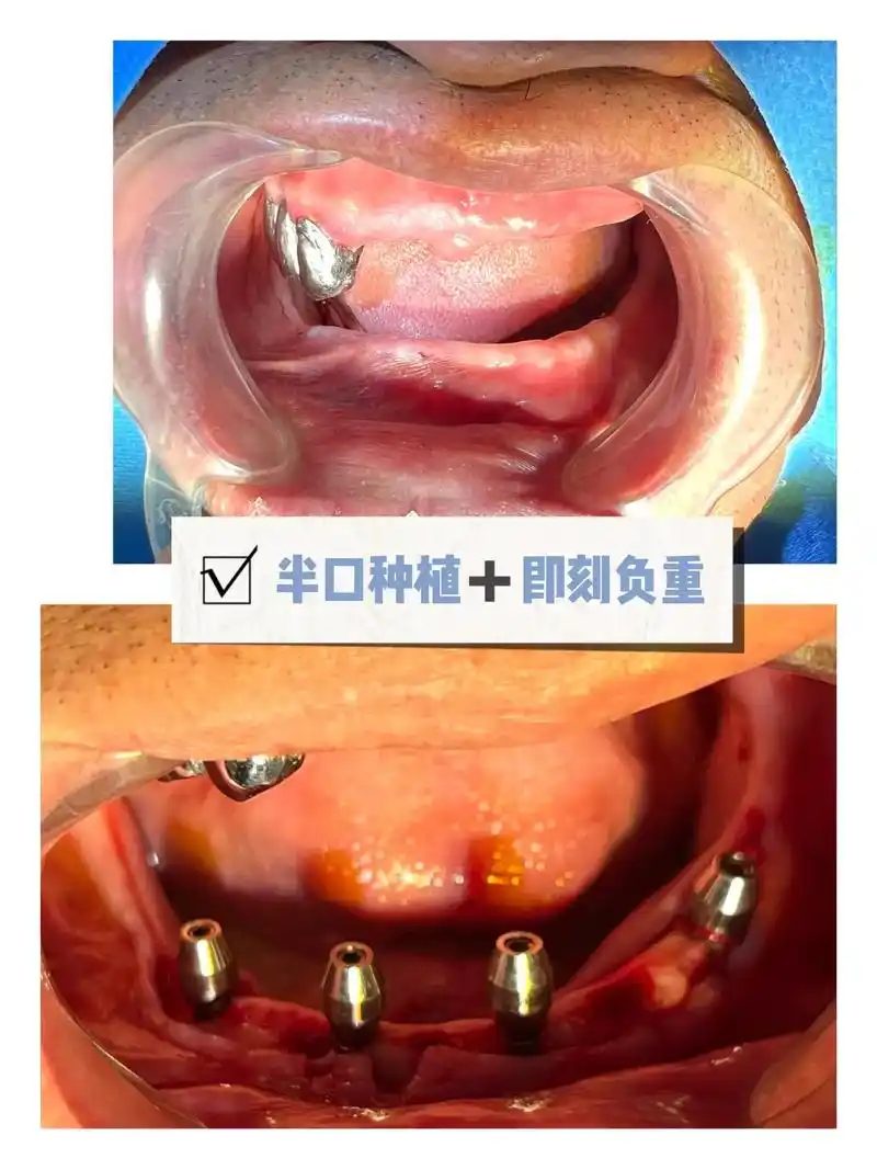 即刻负重种植牙.