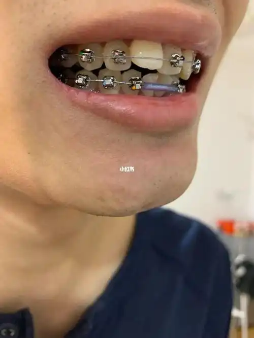 爆牙是指在正畸过程中使用不合理的用力,违背牙齿正常生长发育规律