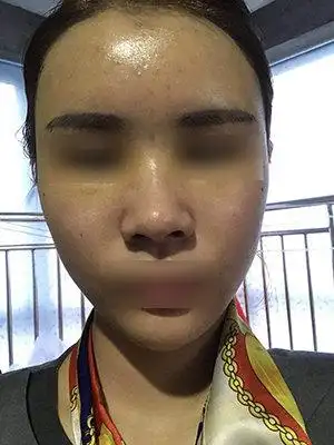 脂肪填充过量失败案例