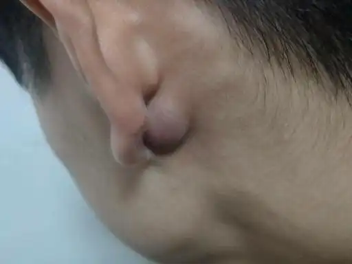 耳朵上长了个包,这是怎么回事
