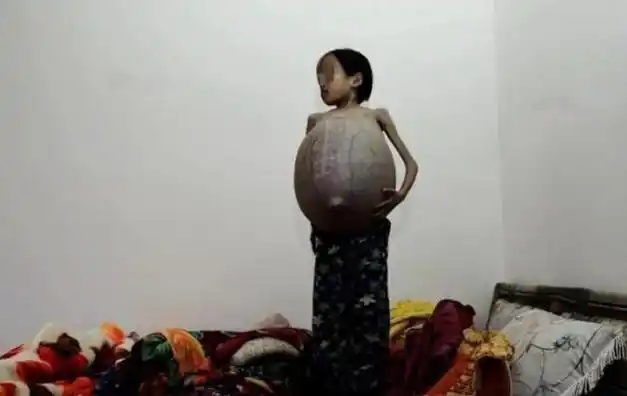 12岁女孩肚子鼓起好像孕妇家人发愁但无计可施