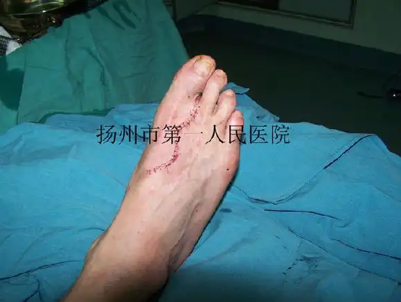 拇指再造(游离第二足趾移植) - 好大夫在线