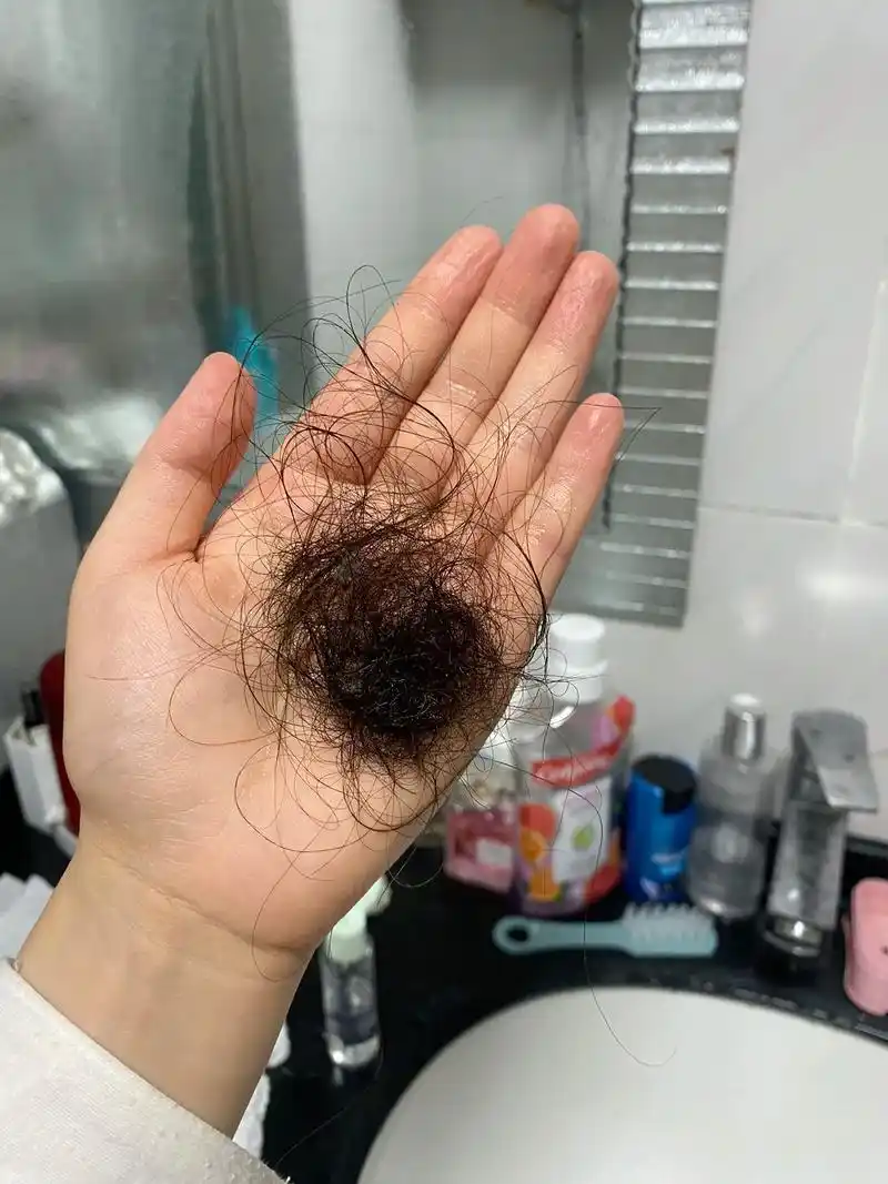 产后脱发.