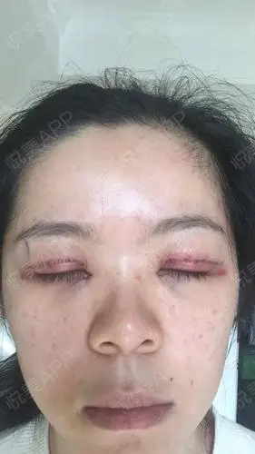上睑下垂矫正术后3天_全切双眼皮术后3天_眼型矫正术后3天_眼整形失败
