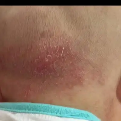 宝宝后脑勺很红还掉皮了,是热的吗?有没有宝妈遇到这样的问题.