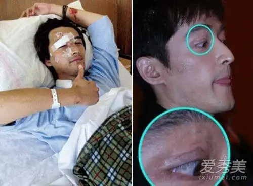从仙剑到琅琊榜 胡歌车祸后残缺双眼皮怎么破