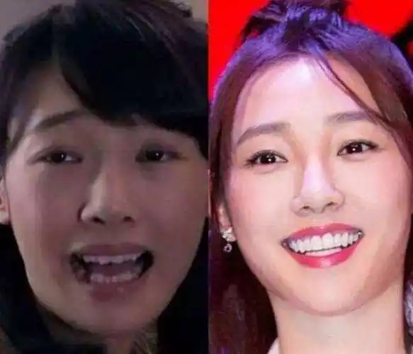 明星烤瓷牙变灾难,嘴包不住牙,嘴凸,变老,演戏难看_牙齿_观众_刘涛