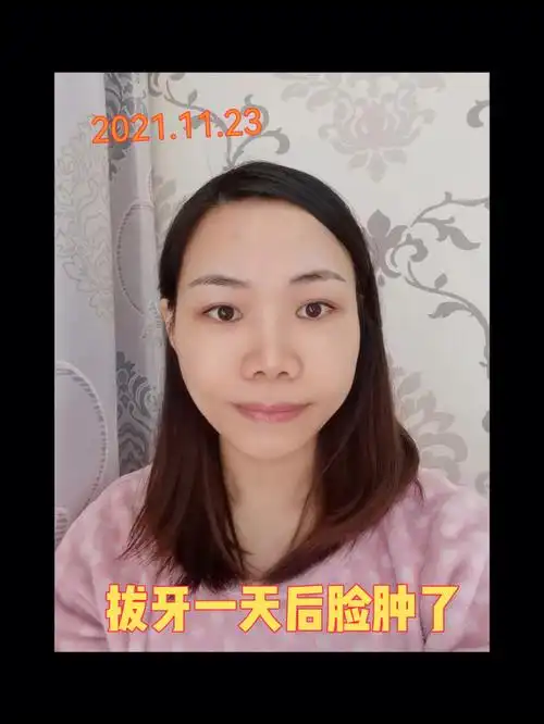 大龄正畸日记打骨钉拔牙