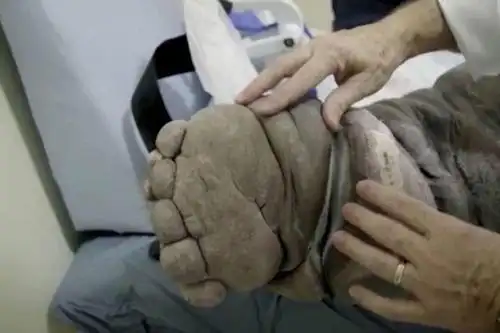 男子左腿变异成大象腿,走路都成困难,"真凶"让人害怕又无奈